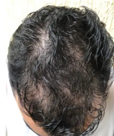 Gadiel anteriormente ao tratamento da calvície