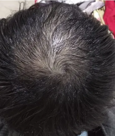 Marco posteriormente ao tratamento