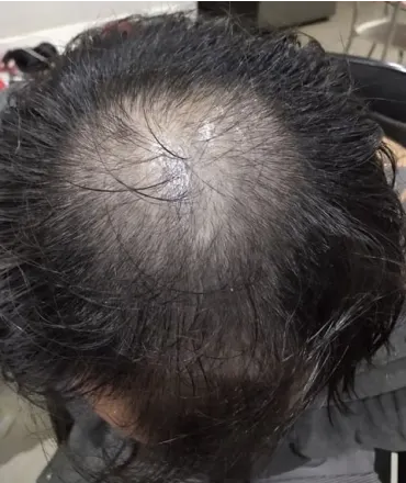 Marco anteriormente ao tratamento da calvície