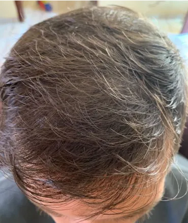 Rafael posteriormente ao tratamento