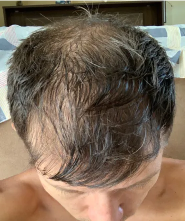 Rafael anteriormente ao tratamento da calvície